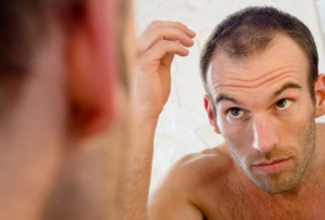Commonly posed questions about Male Pattern Baldness
